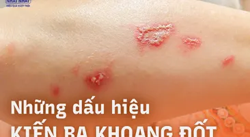 Những dấu hiệu kiến ba khoang đốt dễ nhận biết