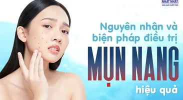 Nguyên nhân và các biện pháp điều trị mụn nang hiệu quả