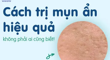Cách trị mụn ẩn hiệu quả, không phải ai cũng biết!