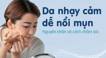 Da nhạy cảm dễ nổi mụn: Nguyên nhân và cách chăm sóc