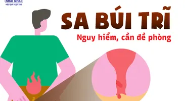 Sa búi trĩ – bệnh tế nhị nhưng nguy hiểm, cần đề phòng