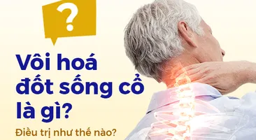 Vôi hóa đốt sống cổ là gì? Điều trị như thế nào?