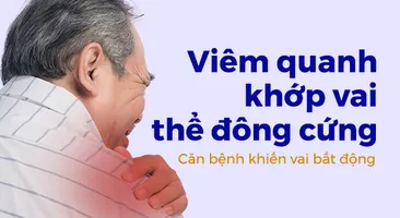 Viêm quanh khớp vai thể đông cứng – Căn bệnh khiến vai bất động