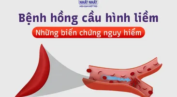 Bệnh hồng cầu hình liềm và những biến chứng nguy hiểm