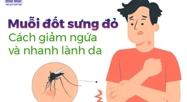 Muỗi đốt sưng đỏ: Cách giảm ngứa và nhanh lành da