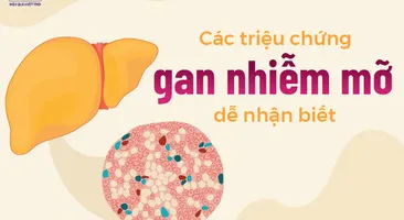 Các triệu chứng gan nhiễm mỡ dễ nhận biết 