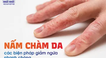 Nấm chàm da – tiết lộ các biện pháp giảm ngứa nhanh chóng