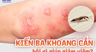 Kiến ba khoang cắn bôi gì giúp giảm viêm, ngăn ngừa sẹo?