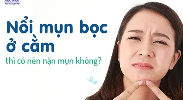 Nổi mụn bọc ở cằm thì có nên nặn mụn không?
