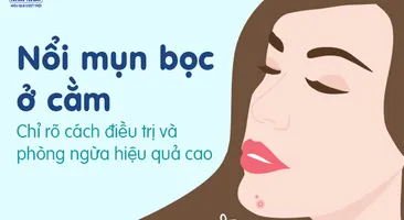 Nổi mụn bọc ở cằm: Chỉ rõ cách điều trị và phòng ngừa hiệu quả cao