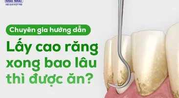 Chuyên gia hướng dẫn: Lấy cao răng xong bao lâu thì được ăn?