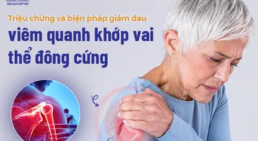 Các triệu chứng và biện pháp giảm đau viêm quanh khớp vai thể đông cứng