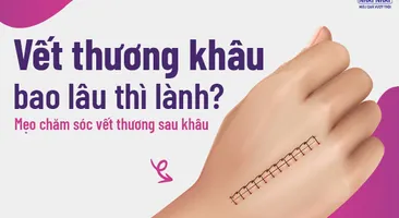 Vết thương khâu bao lâu thì lành? Mẹo chăm sóc vết thương sau khâu