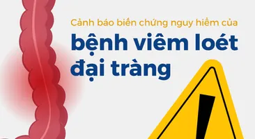 Cảnh báo biến chứng nguy hiểm của bệnh viêm loét đại tràng