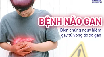 Bệnh não gan: Biến chứng nguy hiểm gây tử vong do xơ gan