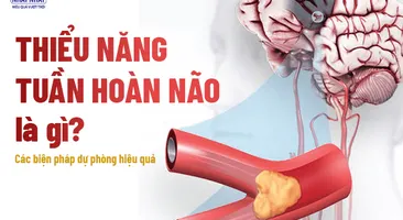 Thiểu năng tuần hoàn não là gì? Các biện pháp dự phòng hiệu quả