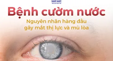 Bệnh cườm nước: Nguyên nhân hàng đầu gây mất thị lực và mù lòa 