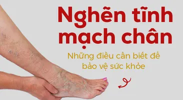 Nghẽn tĩnh mạch chân – Những điều cần biết để bảo vệ sức khỏe