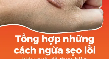 Tổng hợp những cách ngừa sẹo lồi hiệu quả, dễ thực hiện