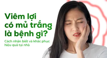 Viêm lợi có mủ trắng là bệnh gì? Cách nhận biết và khắc phục hiệu quả tại nhà