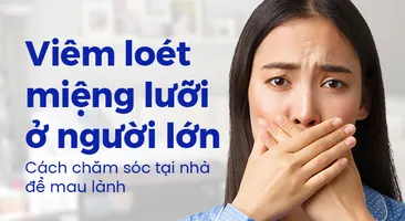 Viêm loét miệng lưỡi ở người lớn: Cách chăm sóc tại nhà để mau lành