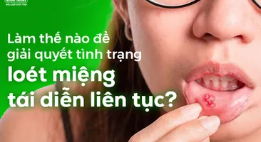 Làm thế nào để giải quyết tình trạng loét miệng tái diễn liên tục?