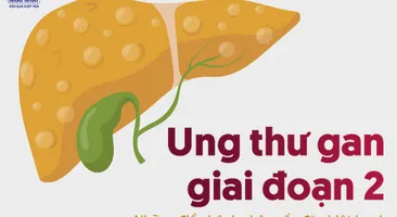 Ung thư gan giai đoạn 2: Những điều bệnh nhân cần đặc biệt lưu ý