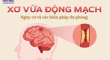 Xơ vữa động mạch: Nguy cơ và các biện pháp dự phòng