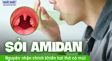 Sỏi amidan: Nguyên nhân chính khiến hơi thở có mùi mà nhiều người chưa biết