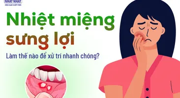 Nhiệt miệng sưng lợi: Làm thế nào để xử trí nhanh chóng?