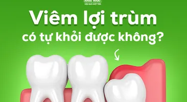 Hỏi nhanh đáp gọn: Viêm lợi trùm có tự khỏi được không? 