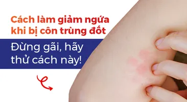 Cách làm giảm ngứa khi bị côn trùng đốt: Đừng gãi, hãy thử cách này!