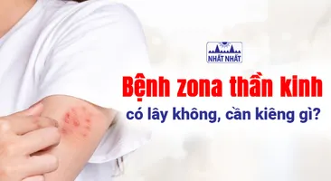 Bệnh zona thần kinh có lây không, cần kiêng gì?