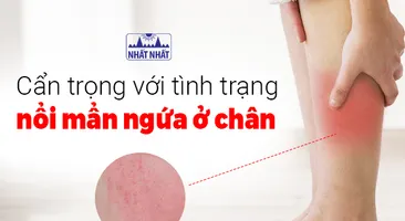 Cẩn trọng với tình trạng nổi mẩn ngứa ở chân