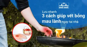 Lưu nhanh 3 cách giúp vết bỏng mau lành ngay tại nhà