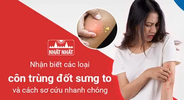 Nhận biết các loại côn trùng đốt sưng to và cách sơ cứu nhanh chóng