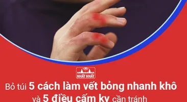 Bỏ túi 5 cách làm vết bỏng nhanh khô và 5 điều cấm kỵ cần tránh