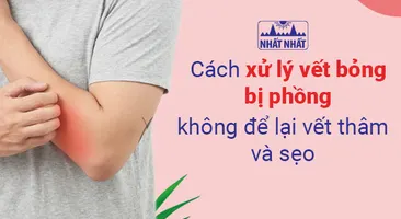 Cách xử lý vết bỏng bị phồng, không để lại vết thâm và sẹo