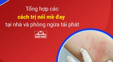 Tổng hợp các cách trị nổi mề đay tại nhà và phòng ngừa tái phát