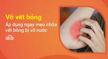 Vỡ vết bỏng - Áp dụng ngay mẹo chữa vết bỏng bị vỡ nước