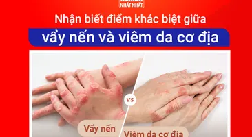 Nhận biết điểm khác biệt giữa vẩy nến và viêm da cơ địa