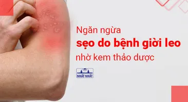 Ngăn ngừa sẹo do bệnh giời leo nhờ kem thảo dược