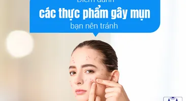 Điểm danh các thực phẩm gây mụn bạn nên tránh