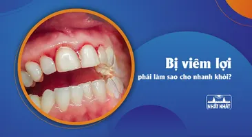 Giải đáp thắc mắc “Bị viêm lợi phải làm sao cho nhanh khỏi?”
