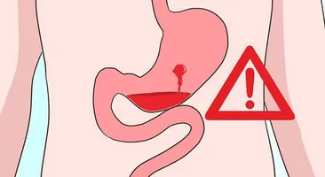 Xuất huyết dạ dày có phải mổ không? Lưu ý chăm sóc sau khi mổ