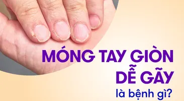 Móng tay giòn dễ gãy là bệnh gì, thiếu chất gì?