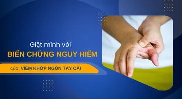 Giật mình với biến chứng nguy hiểm của viêm khớp ngón tay cái