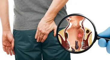 Trĩ hỗn hợp độ 2 có nguy hiểm không? Cách phòng ngừa và điều trị