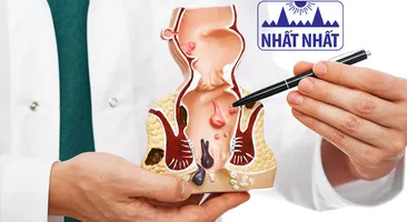 Những điều cần biết về bệnh trĩ và cách điều trị tại nhà