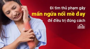 Đi tìm thủ phạm gây mẩn ngứa nổi mề đay để điều trị đúng cách
